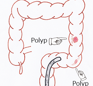 polyp